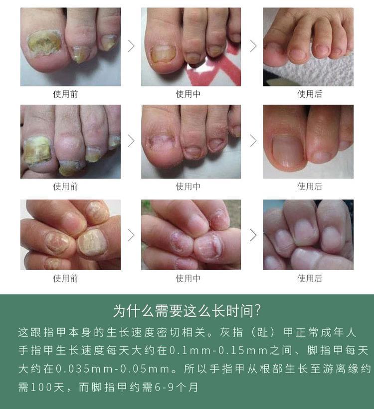 灰指甲液oem貼牌產品